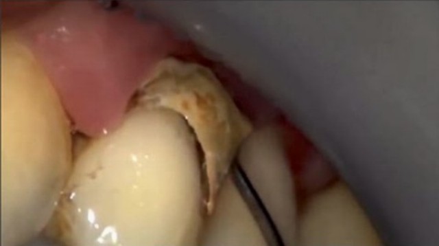 Ako sa odstraňuje zubný kameň