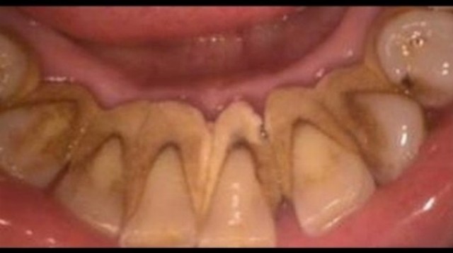 Odstraňovanie nadbytočného zubného povlaku