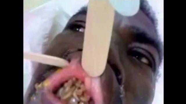 Pacient s červíkmi v ústach medzi zubami
